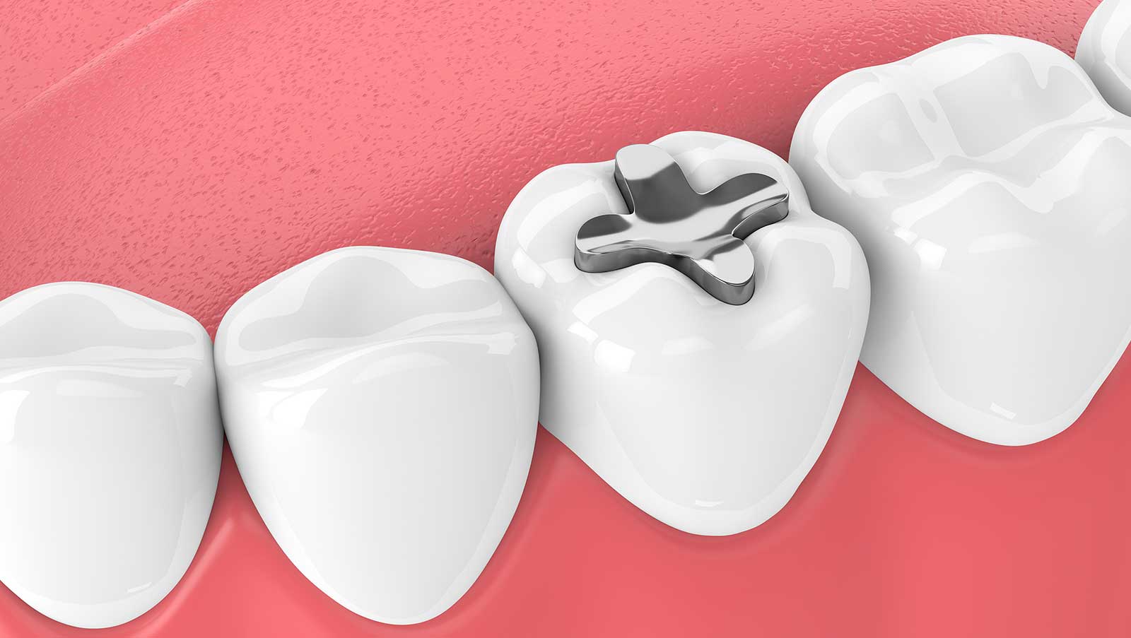 Tooth-Colored Dental Fillings